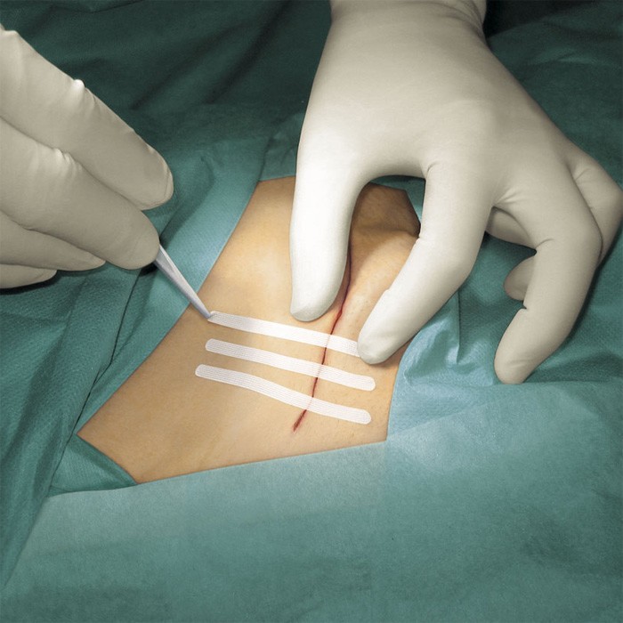 BSN Leukoplast wound closure strip  