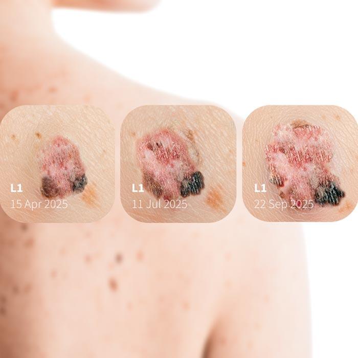 DermLite DL5 Plus Dermatoskop