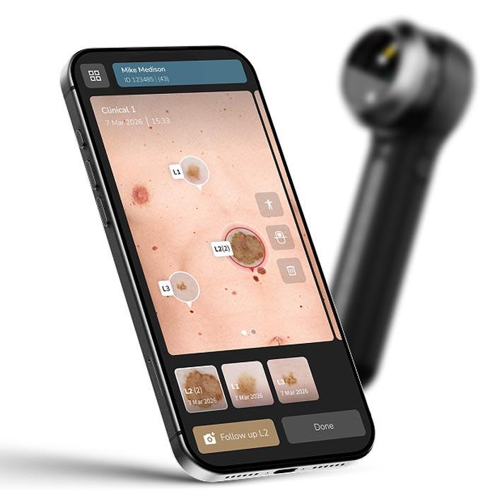 DermLite DL5 Plus Dermatoskop