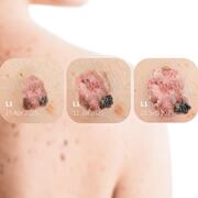 DermLite DL5 Plus Dermatoskop